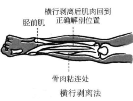 横行剥离法
