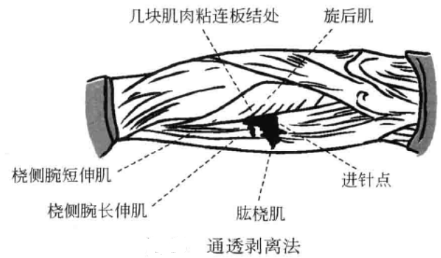 通透剥离法