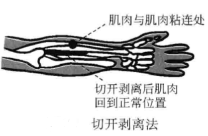 切开剥离法