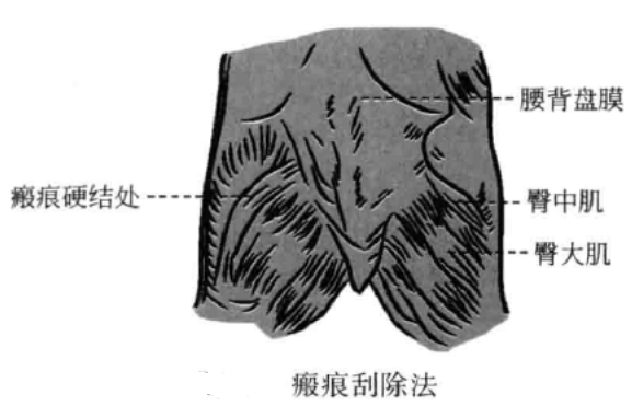瘢痕刮除法