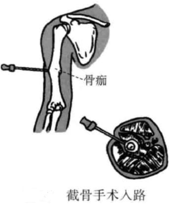 截骨手术入路