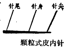 颗粒式皮内针